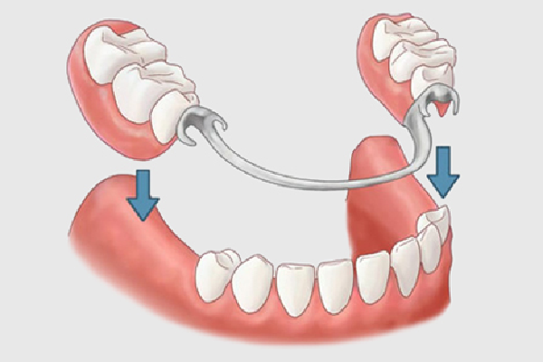 REMOVABLE DENTURES