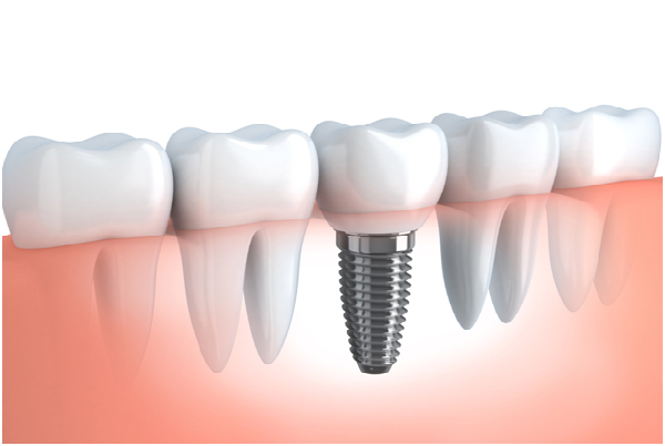 DENTAL IMPLANTS