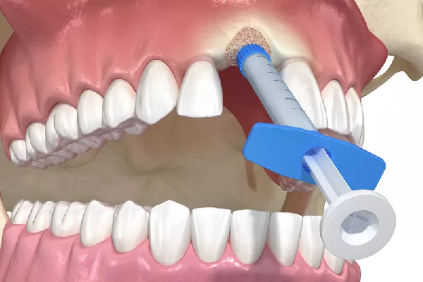 BONE GRAFTING