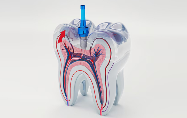 PAINLESS ROOT CANAL TREATMENT