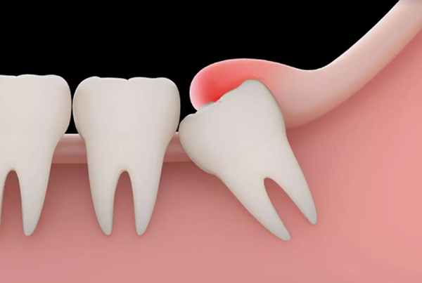 THIRD MOLAR WISDOM MOLAR EXTRACTION